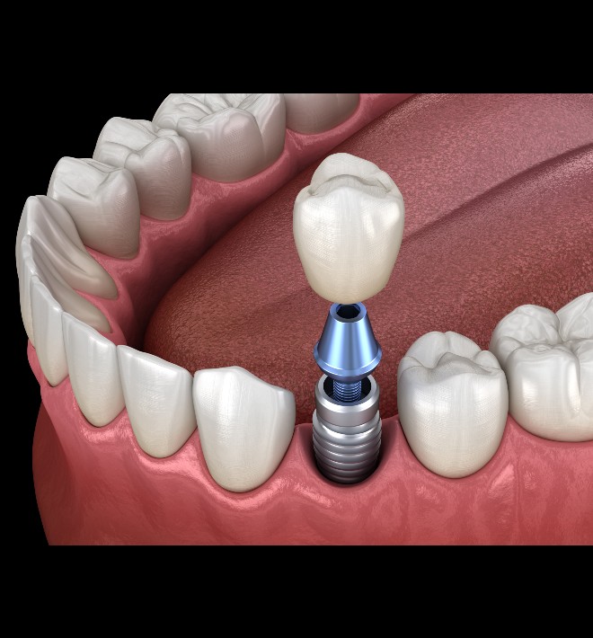 single-tooth-implants-perth