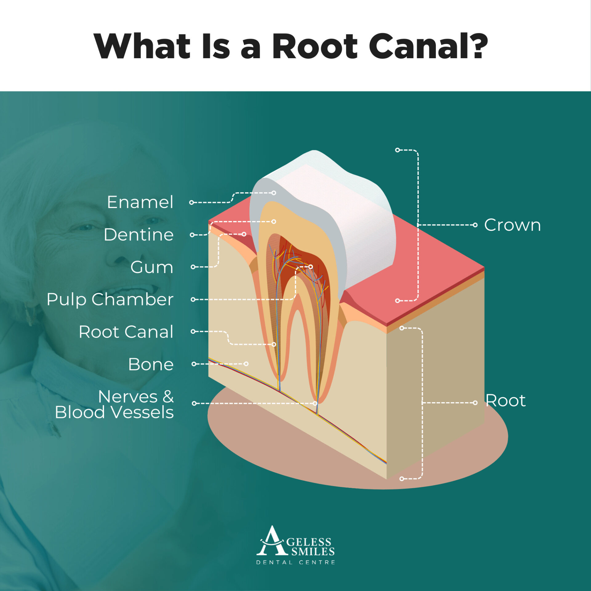 root canal perth m