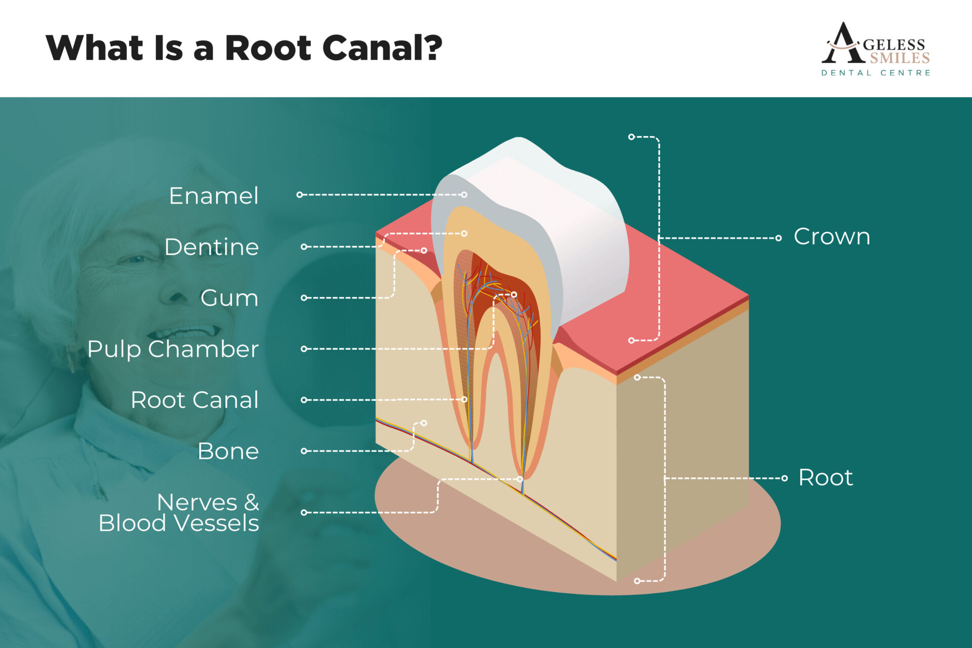 root canal perth